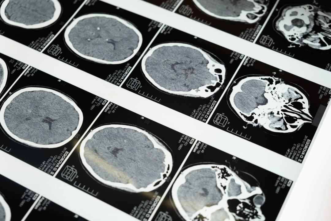 Neurokirurgija