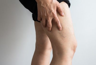 Varicose veins on the elderly asian woman leg,Close up